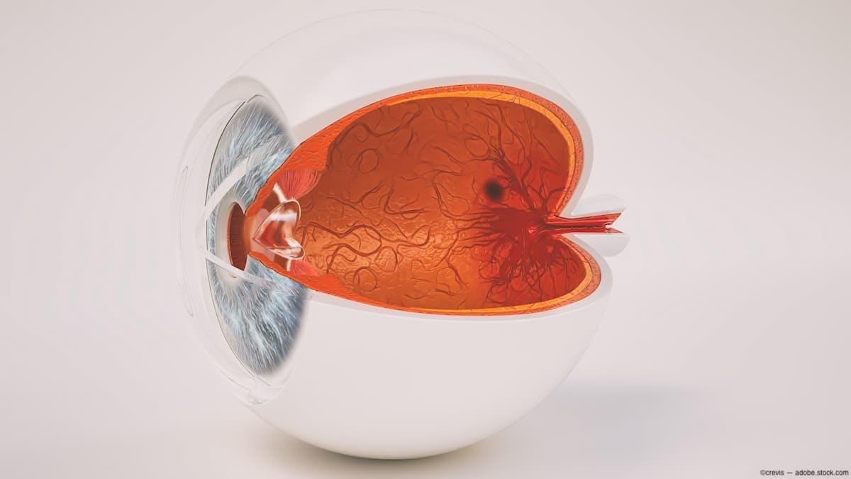Vision-related quality of life in patients with RVO