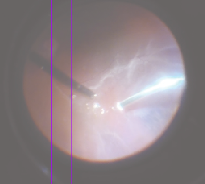 Figure 1 Intraoperative image showing bubbles caused by the cavitation phenomenon during vitrectomy. (Image courtesy of Jorge Monasterio Bel, MD)