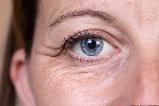 AAO 2024: New drug shows promise as first to protect vision in patients with dry AMD