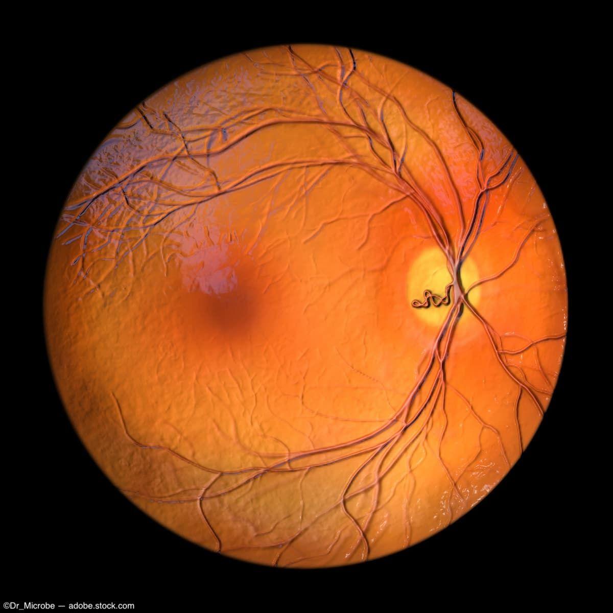 EURETINA 2024: Cardio-ocular syndrome and retinal microvasculature changes in acute heart failure