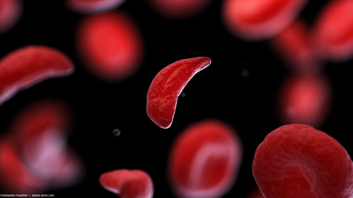 Study examines sickle cell disease and risk of large vessel retinal vascular occlusion 