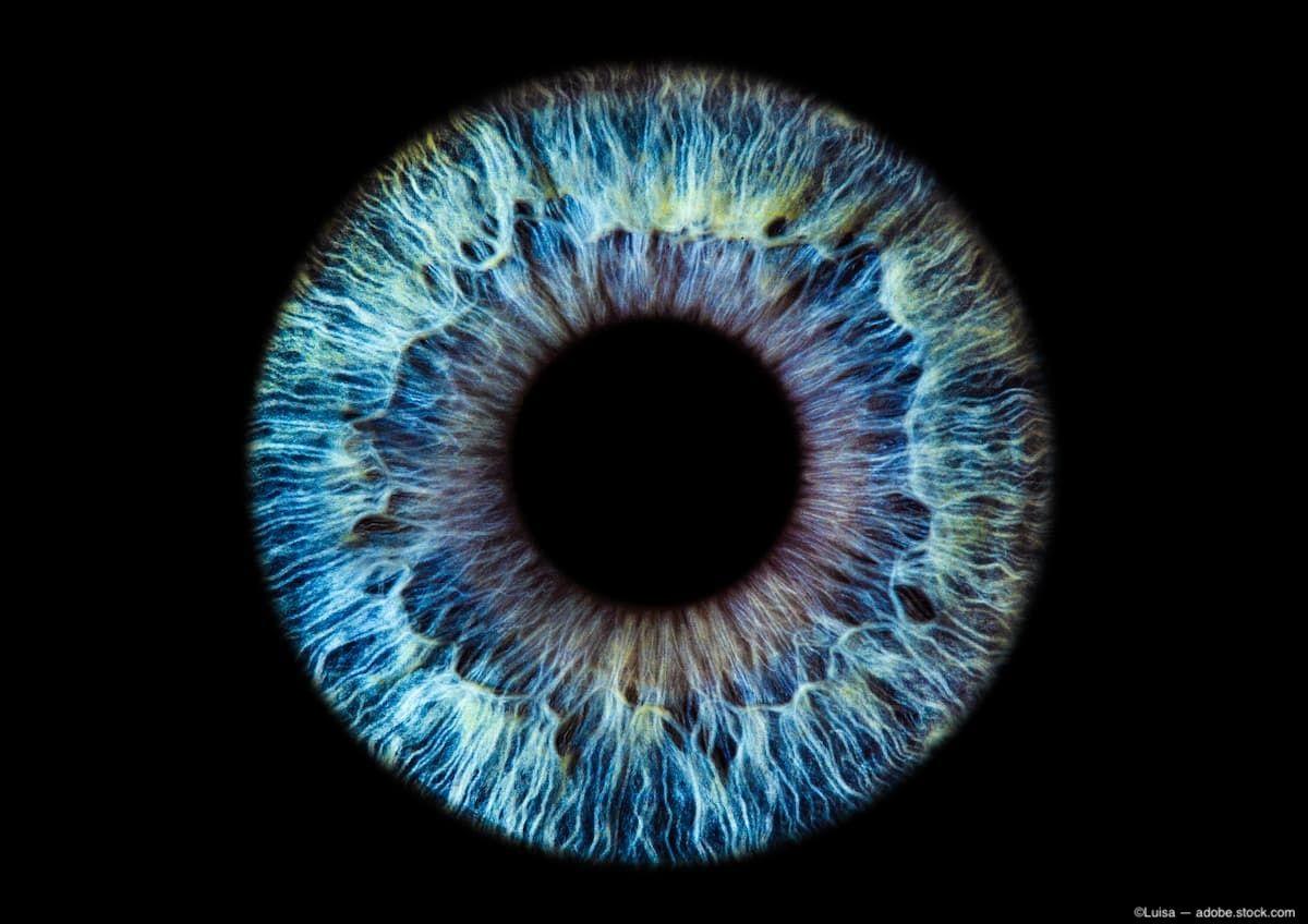 Iris freckles: Potential biomarker for AMD