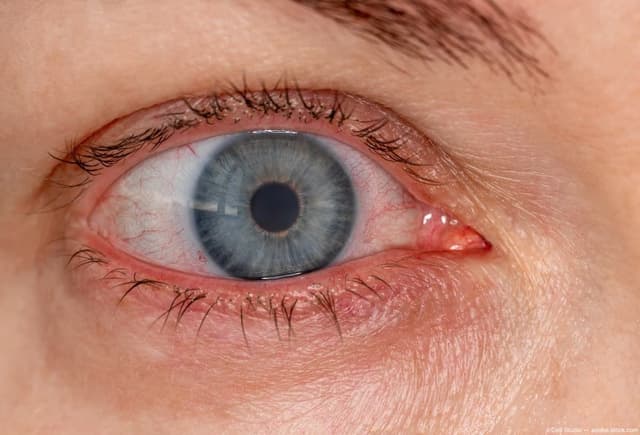 Sterile intraocular inflammation associated with faricimab